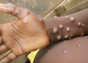 Monkeypox