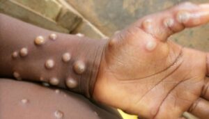 Monkeypox