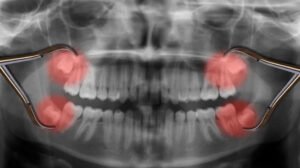 Tooth Extraction Explained
