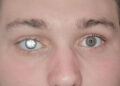 Citizen surprises everyone by getting diamond in eye after losing eyesight
