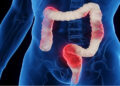 Boy loses intestines after swallowing 100 magnets in New Zealand.