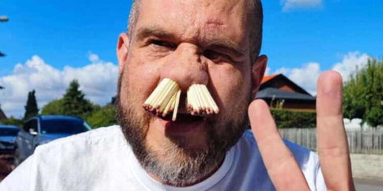 Sweden: Unique record of 81 matchsticks stuck in nose.