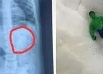 Doctors remove ‘plastic lump’ from 1.5-year-old child’s stomach.