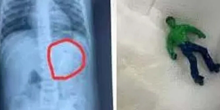 Doctors remove ‘plastic lump’ from 1.5-year-old child’s stomach.
