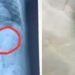 Doctors remove ‘plastic lump’ from 1.5-year-old child’s stomach.