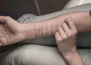 Mysterious deep wound marks on the hands of 35 school students.