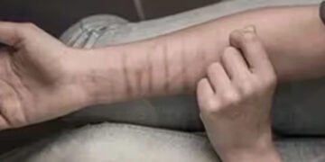 Mysterious deep wound marks on the hands of 35 school students.