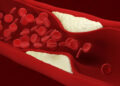 How to remove fat accumulated in the arteries?