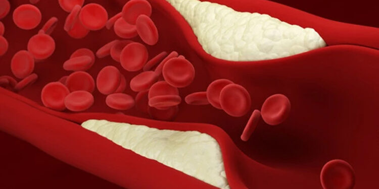 How to remove fat accumulated in the arteries?