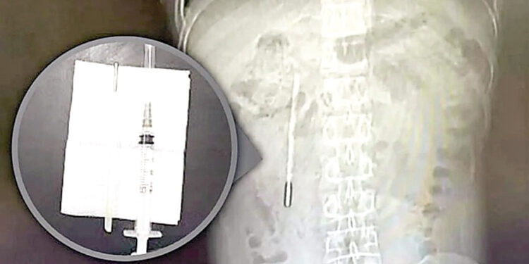 Thermometer swallowed as a child removed from stomach in China.